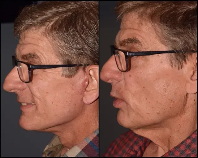 Face & Neck Lift